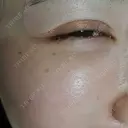 シワ取りボトックス 湘南美容クリニック 仙台院 DAY 52 サムネイル用