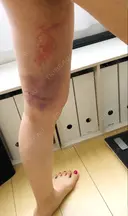 クマ治療 / 脂肪吸引（脚） / 下まぶたたるみ取り / 下まぶたの脂肪取り 湘南美容クリニック 千葉センシティ院 DAY 3 サムネイル用