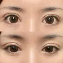 二重切開 / 眼瞼下垂（切開） / 目元修正 シエルクリニック DAY 15 サムネイル用