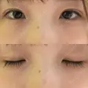 二重埋没 湘南美容クリニック 赤坂見附院 AFTER サムネイル用