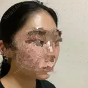 骨削り（頬） ボンディ美容整形外科（旧リオン整形外科） DAY 203 サムネイル用