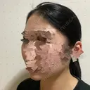 骨削り（頬） ボンディ美容整形外科（旧リオン整形外科） DAY 203 サムネイル用