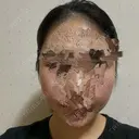 骨削り（頬） ボンディ美容整形外科（旧リオン整形外科） AFTER サムネイル用