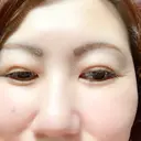 下まぶたの脂肪取り 湘南美容クリニック 千葉センシティ院 DAY 29 サムネイル用