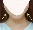 糸リフト / 脂肪吸引（顔） / その他（輪郭） / 切開リフト 清潭清楚整形外科 DAY 63 サムネイル用