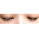 二重切開 神野美容形成外科クリニック AFTER サムネイル用