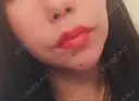 ヒアルロン酸注入（唇） / ボトックス（口角） id美容クリニック 銀座院 AFTER サムネイル用