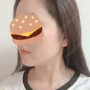 糸リフト / 骨切り（あご） / 骨削り（エラ） / 骨削り（頬） / 脂肪吸引（顔） RG整形外科（旧リオン整形外科） DAY 258 サムネイル用