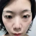 ハイフ（顔） 共立美容外科 仙台院 DAY 0 サムネイル用