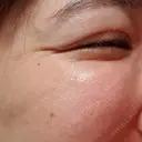 シワ取りボトックス 湘南美容クリニック 仙台院 DAY 56 サムネイル用