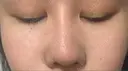 鼻尖形成（切開） / 骨切幅寄せ / ワシ鼻修正・ハンプ切除 / 眉間プロテーゼ ララ整形外科 AFTER サムネイル用
