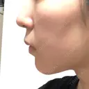 脂肪吸引（顔） / メーラーファット除去 / ボトックス（あご） WOM CLINIC GINZA （ワム クリニック ギンザ） DAY 31 サムネイル用