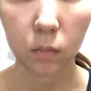 脂肪吸引（顔） / メーラーファット除去 / ボトックス（あご） WOM CLINIC GINZA （ワム クリニック ギンザ） DAY 31 サムネイル用