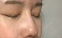 鼻尖形成（切開） / 骨切幅寄せ / ワシ鼻修正・ハンプ切除 / 眉間プロテーゼ ララ整形外科 DAY 224 サムネイル用