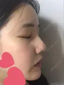 鼻尖形成（切開） / 骨切幅寄せ / ワシ鼻修正・ハンプ切除 / 眉間プロテーゼ ララ整形外科 DAY 224 サムネイル用