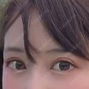 クマ治療 TCB東京中央美容外科 中野院 AFTER サムネイル用