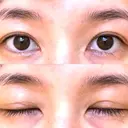 二重埋没 城本クリニック 立川院 AFTER サムネイル用