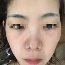 ハイフ（顔） 共立美容外科 仙台院 DAY 1 サムネイル用