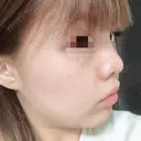 鼻尖形成（切開） / 小鼻縮小（切開） / 軟骨移植 / 眉間プロテーゼ 湘南美容クリニック 広島院 DAY 75 サムネイル用