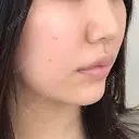 その他（肌） A CLINIC（エークリニック） 横浜院 DAY 0 サムネイル用