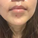 ボトックス（あご） / ヒアルロン酸注入（あご） 湘南美容クリニック 大阪京橋院 AFTER サムネイル用