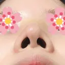 鼻尖形成（切開） / ヒアルロン酸注入（鼻） 東京ヒルズクリニック 新宿院 DAY 4 サムネイル用