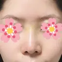 鼻尖形成（切開） / ヒアルロン酸注入（鼻） 東京ヒルズクリニック 新宿院 DAY 4 サムネイル用