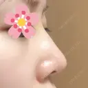 鼻尖形成（切開） / ヒアルロン酸注入（鼻） 東京ヒルズクリニック 新宿院 DAY 4 サムネイル用