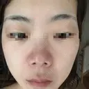 ハイフ（顔） 共立美容外科 仙台院 DAY 3 サムネイル用