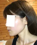 糸リフト / バッカルファット除去 / 脂肪吸引（顔） / ボトックス（エラ・小顔） 湘南美容クリニック 秋葉原院 DAY 59 サムネイル用