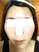 糸リフト / バッカルファット除去 / 脂肪吸引（顔） / ボトックス（エラ・小顔） 湘南美容クリニック 秋葉原院 DAY 59 サムネイル用