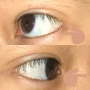 二重埋没 / 自然癒着法 表参道スキンクリニック 名古屋院（DAILY SKIN CLINIC提携院） DAY 17 サムネイル用