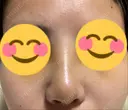 隆鼻術 たにまちクリニック DAY 4 サムネイル用