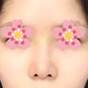 鼻尖形成（切開） / ヒアルロン酸注入（鼻） 東京ヒルズクリニック 新宿院 DAY 6 サムネイル用