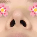 鼻尖形成（切開） / ヒアルロン酸注入（鼻） 東京ヒルズクリニック 新宿院 DAY 6 サムネイル用