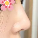 鼻尖形成（切開） / ヒアルロン酸注入（鼻） 東京ヒルズクリニック 新宿院 DAY 6 サムネイル用