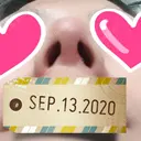 鼻尖形成（切開） / 小鼻縮小（切開） / 軟骨移植 湘南美容クリニック 船橋院 DAY 35 サムネイル用