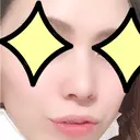 鼻尖形成（切開） / 小鼻縮小（切開） / 軟骨移植 湘南美容クリニック 船橋院 DAY 35 サムネイル用