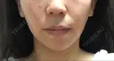 バッカルファット除去 / 脂肪吸引（顔） 湘南美容クリニック 那覇院 DAY 111 サムネイル用