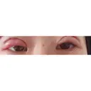 眼瞼下垂（切開） リビジョンクリニック（旧：池本形成外科・美容外科） DAY 0 サムネイル用
