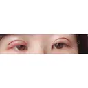 眼瞼下垂（切開） リビジョンクリニック（旧：池本形成外科・美容外科） DAY 1 サムネイル用