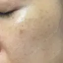 シミ取りレーザー / YAGレーザー 仁愛クリニック DAY 104 サムネイル用