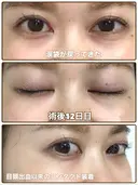 クマ治療 / 脂肪吸引（脚） / 下まぶたたるみ取り / 下まぶたの脂肪取り 湘南美容クリニック 千葉センシティ院 AFTER サムネイル用