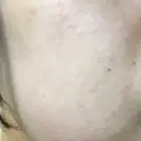 ピーリング（ニキビ・毛穴） 自由が丘クリニック DAY 1 サムネイル用