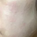 ピーリング（ニキビ・毛穴） 自由が丘クリニック DAY 1 サムネイル用