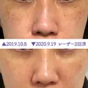 シミ取りレーザー / YAGレーザー 仁愛クリニック AFTER サムネイル用