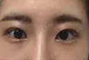 目尻切開 / タレ目形成・グラマラスライン（切開） A CLINIC（エークリニック） 銀座院 DAY 6 サムネイル用