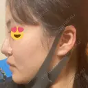 隆鼻術 湘南美容クリニック 岡山院 DAY 0 サムネイル用