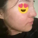 隆鼻術 湘南美容クリニック 岡山院 DAY 0 サムネイル用