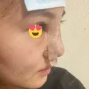 隆鼻術 湘南美容クリニック 岡山院 DAY 1 サムネイル用